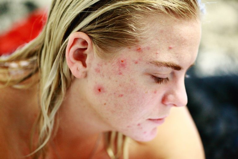 acne and spf