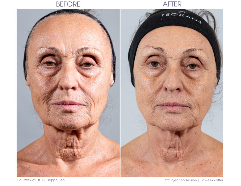 Redensity 1 before and after