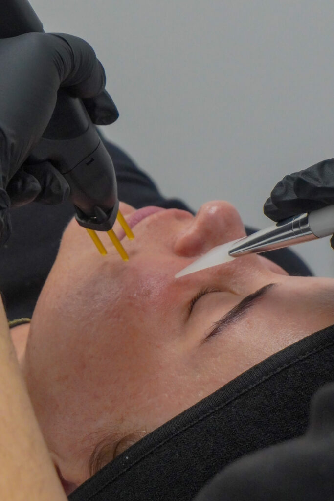 NeoGen Plasma device at Face Oxford for regenerative skin rejuvenation