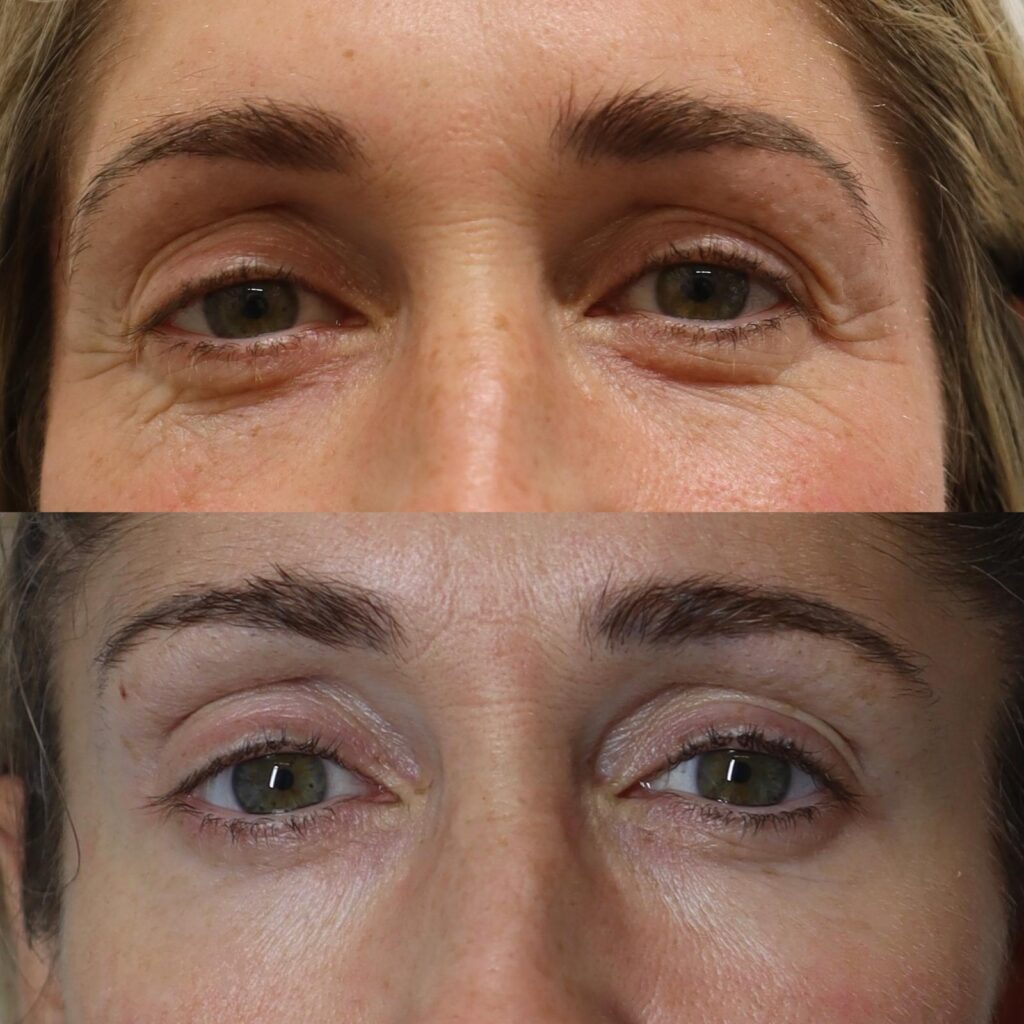 NeoGen Plasma device at Face Oxford for regenerative skin rejuvenation